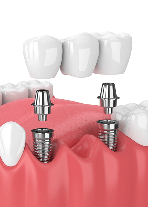 Illustration of a dental bridge.
